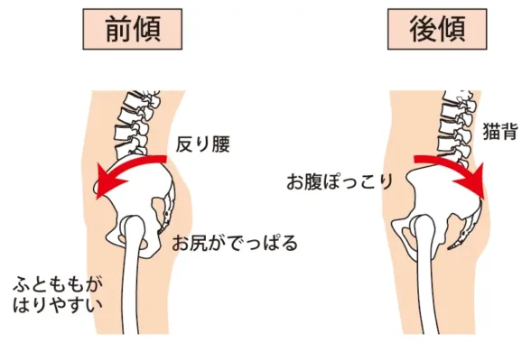 骨盤の前傾と後傾のイラスト