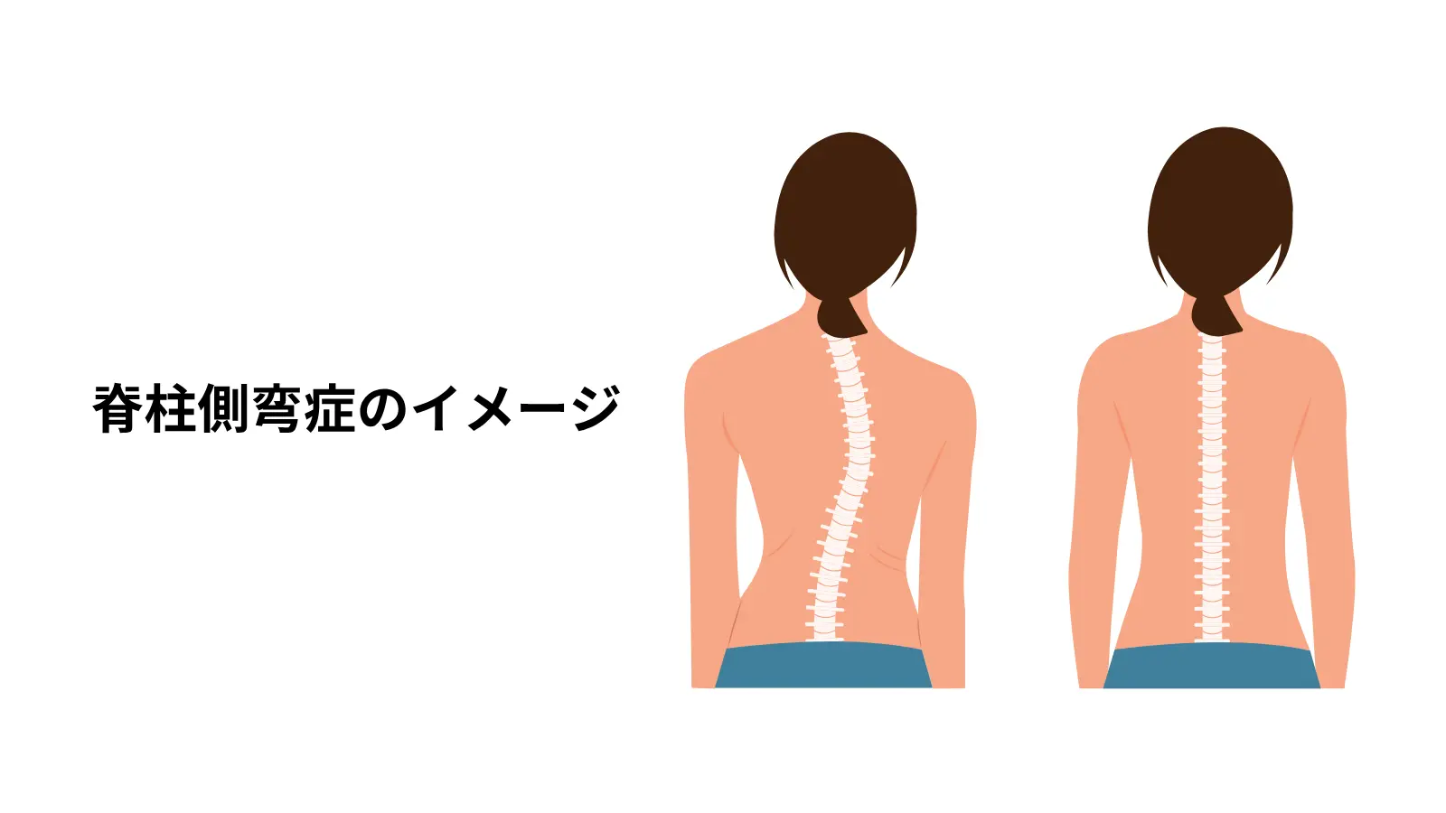 脊柱側弯症のイメージ画像